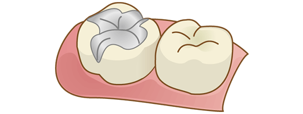 保険診療の詰め物（銀歯）イメージ
