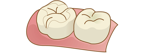 自費診療の詰め物（セラミック）イメージ