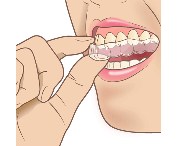 ホームホワイトニングのイメージ