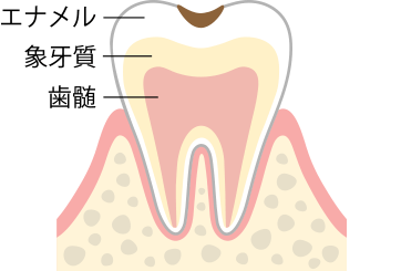 C1　エナメル質の虫歯