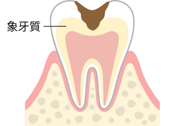 C2　象牙質の虫歯