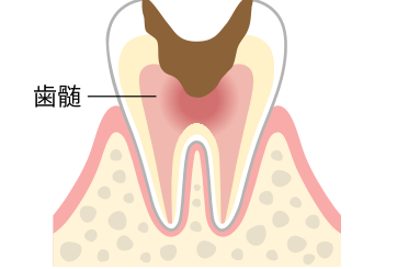 C3　神経（歯髄）の虫歯